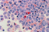 白血病初期小红点图片(白血病初期小红点图片引发的注意，如何识别和治疗？)
